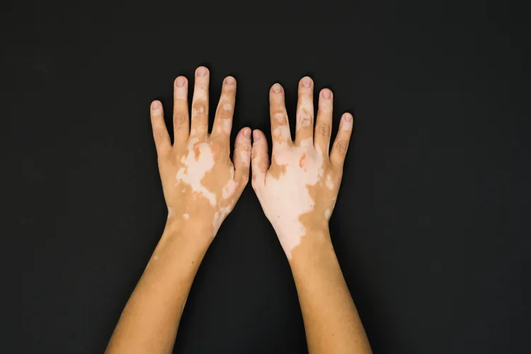 Les anomalies de la peau peuvent être une nuisance - ou une partie de l'identité personnelle. Image : iStock