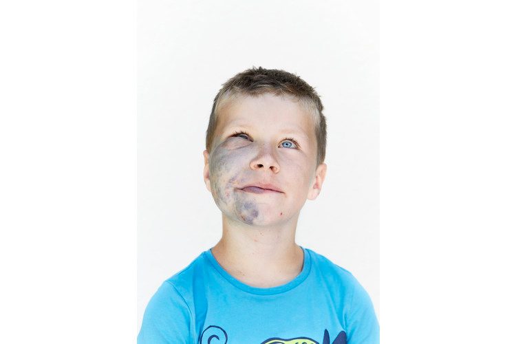 8-year-old Gian lives with a skin abnormality caused by a genetic mutation known as a glomuvenous malformation.