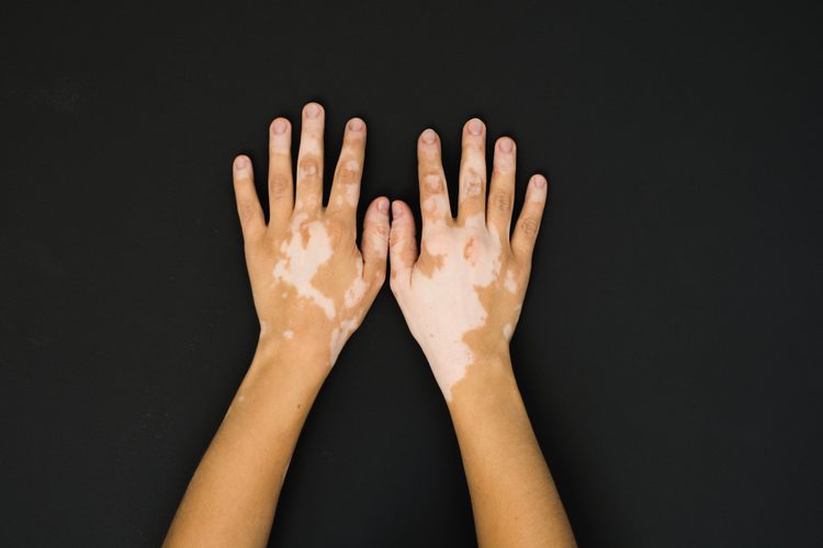 Skin abnormalities can be a burden - or part of your identity. Picture: iStock
