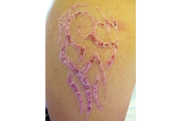 Die Allergie auf die Farbzusatzstoffe ist sehr schmerzhaft und tritt oft in Form des Tattoos auf. Foto: zVg