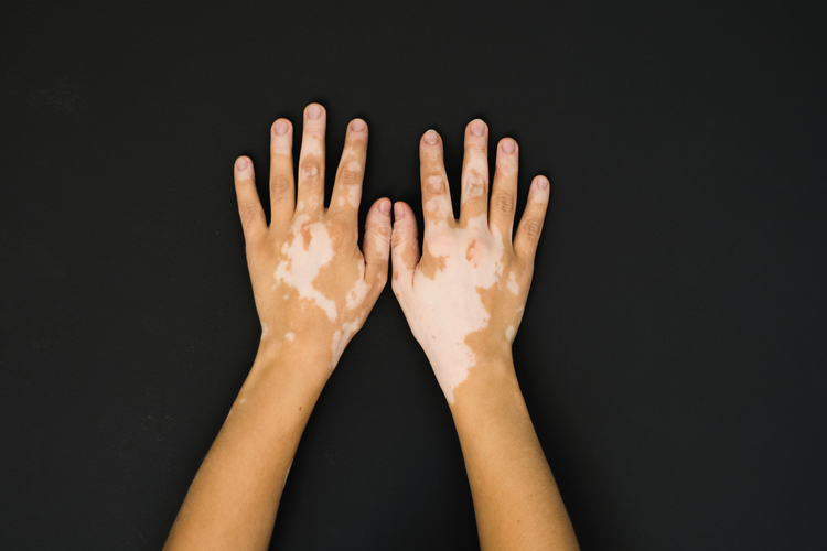 60f57fd43fa4c921ae8b466fd4a5e5f2.jpg Hautauffälligkeiten können eine Belatung sein - oder ein Teil der eigenen Identität. Bild: iStock