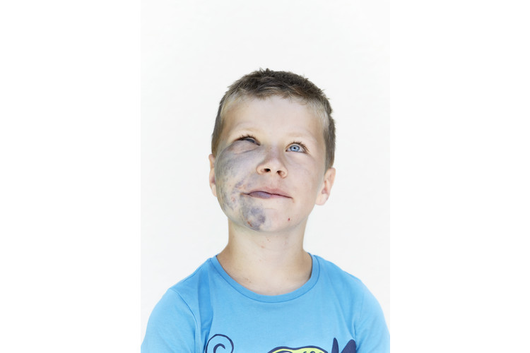 6dd6f0d0cfb7dbf104c50767829f0811.jpg Der 8-jährige Gian lebt mit einer durch Genmutation verursachten Hautauffälligkeit, die als glomuvenöse Malformation bezeichnet wird.